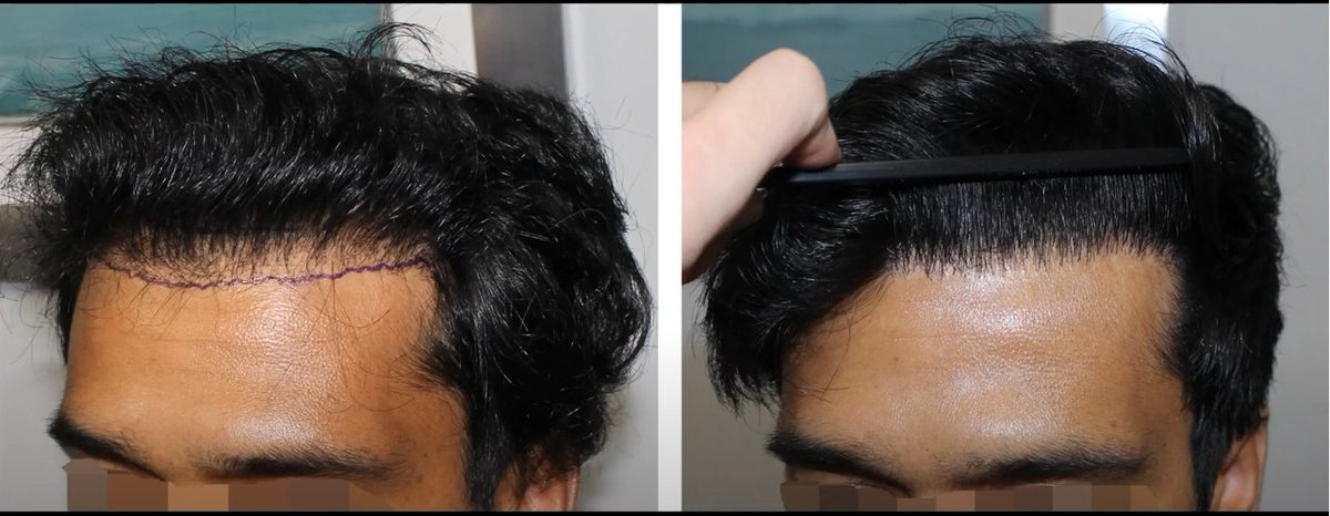 "Hair transplant repair" is a subject no one likes to talk about. And who would? No one wants to believe that they will undergo a cosmetic procedure, like a hair transplant, to improve their appearance, only to need it "repaired" at a later date. fellermedical.com/what-if-i-need…