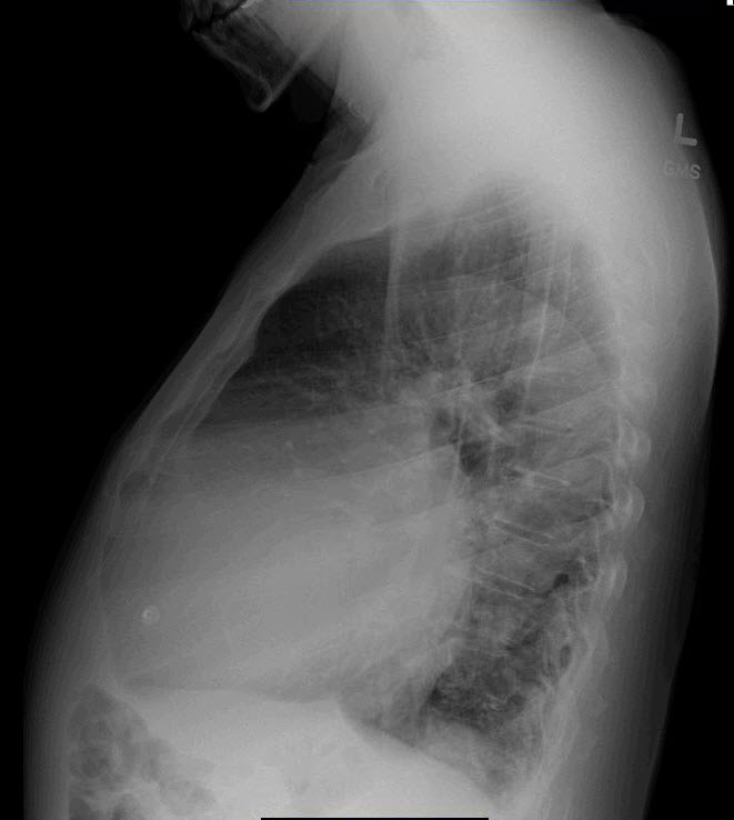 RJonesSonoEM's tweet photo. Pt with systemic AL amyloidosis presents with 1 wk of dyspnea. CXR shown. ?explained by amyloidosis. #POCUS #IMPOCUS #FOAMed #FOAMus #MedTwitter @NephroP @ACEP_EUS @jminardi21 @HeyDrNik @MetroHealth_EM @IMPOCUSFocus @siddharth_dugar @medpedshosp @TomJelic @cianmcdermott @msiuba https://t.co/KvwAfGeGOP