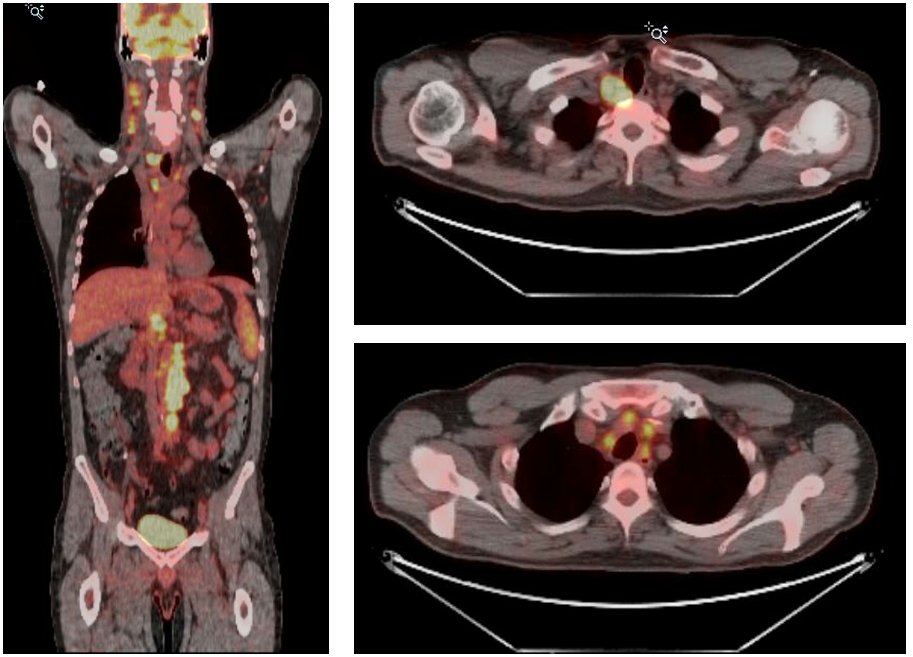 2/ PET/CT showed multiple enlarged lymph nodes concerning for a lymphoproliferative disorder. Among these are multiple mildly enlarged LNs in the porta hepatis and gastrohepatic ligament.