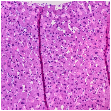 3/ Given the lack of obvious liver involvement, a biopsy of the liver was performed, which showed a sinusoidal infiltrate of lymphocytes.