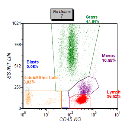 6/ The peripheral blood flow cytometry is back and only makes things stranger. Note the CD4+ T-cells with aberrant loss of surface CD3 and CD5. The loss of CD3 and CD5 is not characteristic of a particular T-cell neoplasm.