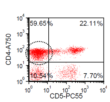 6/ The peripheral blood flow cytometry is back and only makes things stranger. Note the CD4+ T-cells with aberrant loss of surface CD3 and CD5. The loss of CD3 and CD5 is not characteristic of a particular T-cell neoplasm.