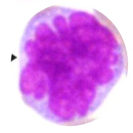 9/HTLV-1, flower cell. Typical boards fodder:- Endemic to Japan, Caribbean, South America- Patients present with hypercalcemia- Infects CD4+ cells(...also HTLV-3 is HIV)