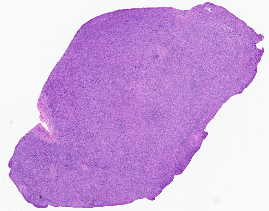 10/The node has arrived! It's effaced. Few atypical cells, mostly small lymphocytes. Is that a high endothelial venule (HEV)?