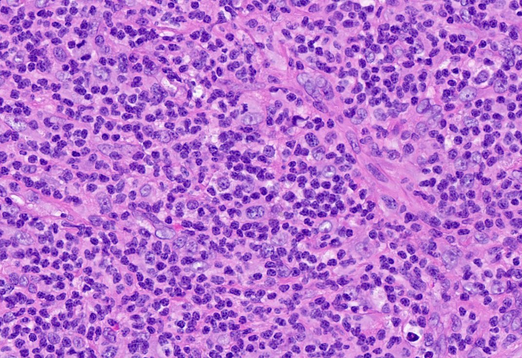 10/The node has arrived! It's effaced. Few atypical cells, mostly small lymphocytes. Is that a high endothelial venule (HEV)?