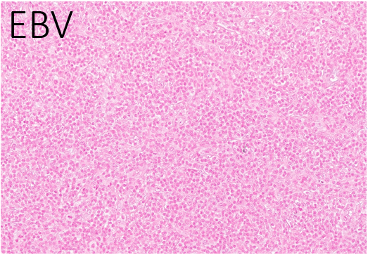 12/ EBV-positive in the background B cells and CD21 to help elucidate the follicular dendritic meshwork. Also, this is a follicular T-cell process, are they present?