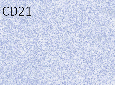 12/ EBV-positive in the background B cells and CD21 to help elucidate the follicular dendritic meshwork. Also, this is a follicular T-cell process, are they present?