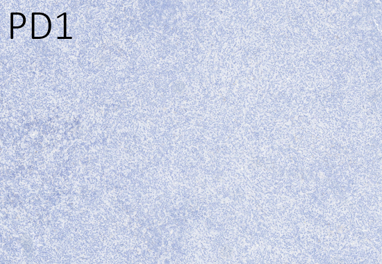 12/ EBV-positive in the background B cells and CD21 to help elucidate the follicular dendritic meshwork. Also, this is a follicular T-cell process, are they present?