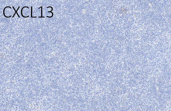 12/ EBV-positive in the background B cells and CD21 to help elucidate the follicular dendritic meshwork. Also, this is a follicular T-cell process, are they present?