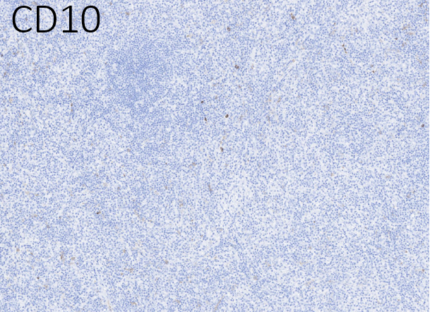 15/Negative CD8, CD10...