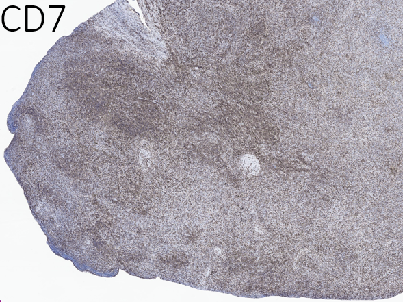 14/Other positive T-cell markers