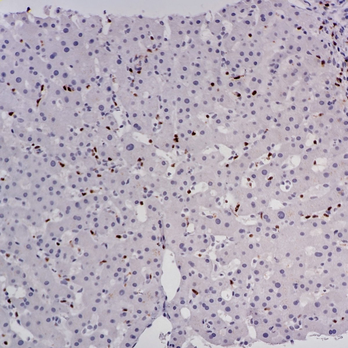 21/I guess we need to revisit that liver biopsy. What does ALK look like? Oh...oh my.