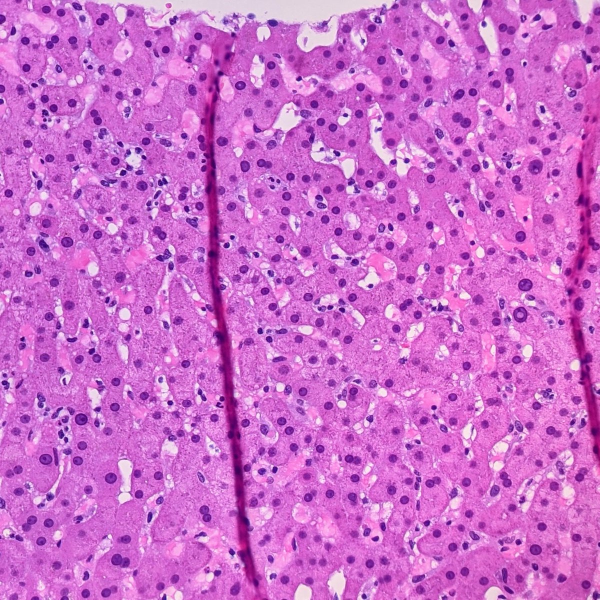 21/I guess we need to revisit that liver biopsy. What does ALK look like? Oh...oh my.