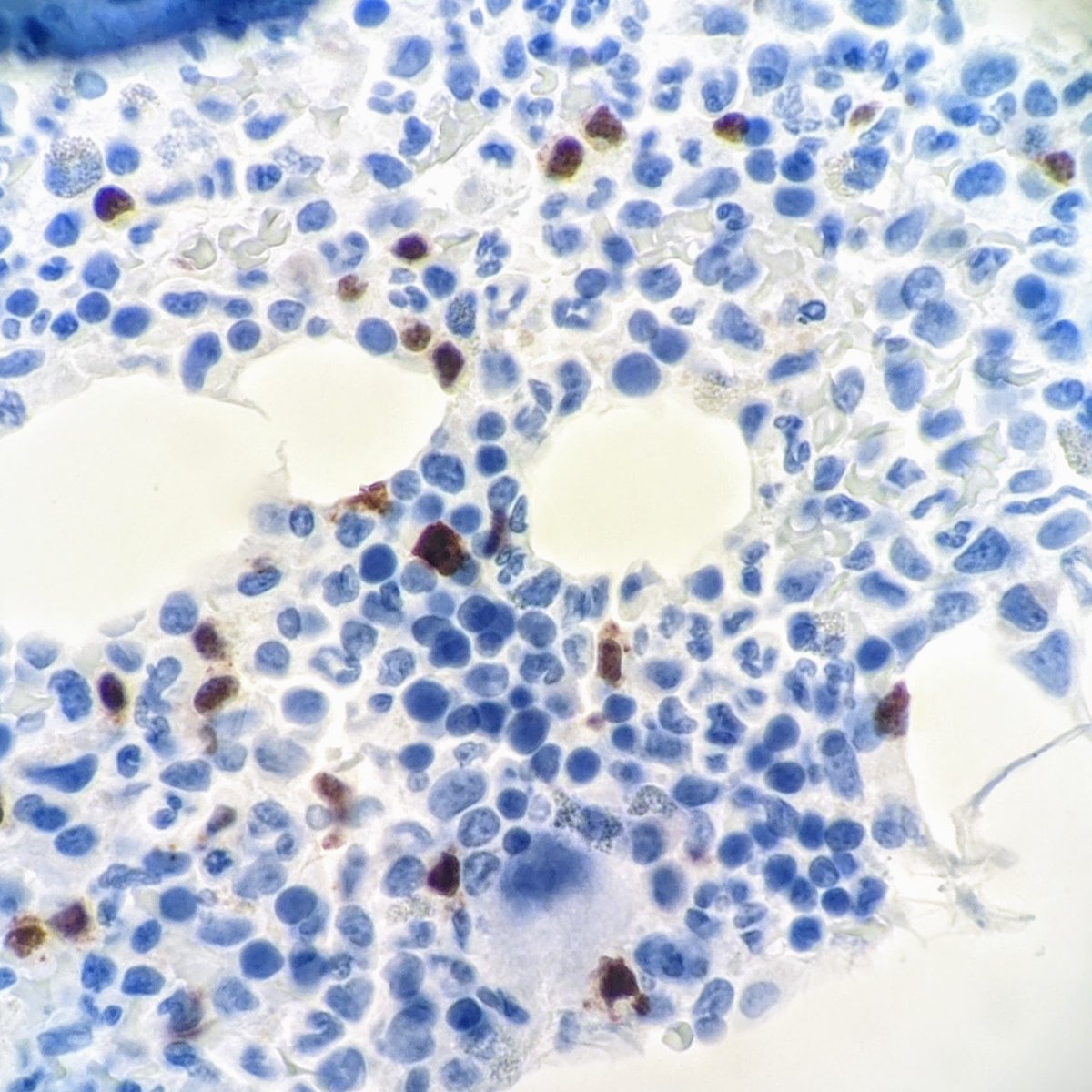 22/And the concurrent bone marrow that you just received? The one with sprinkled T-cells but nothing really crazy going on? What does ALK look like there?