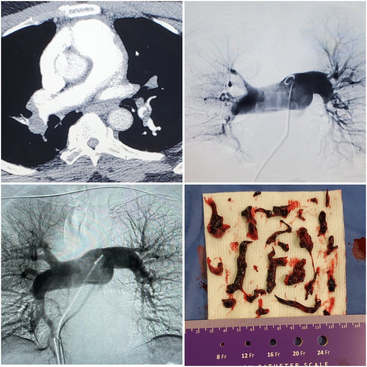 debkumarsarkar's tweet photo. Another submassive PE treated with single session non-lytic thromboaspiration with @InariMedical #flowtriever. PA pressures both peak systolic and mean dropped by 12 mmHg on table, patient feeling great, off O2 and going home on AC POD#1 #paradigmshift #irad #PE #notpa https://t.co/7i434SaaKx