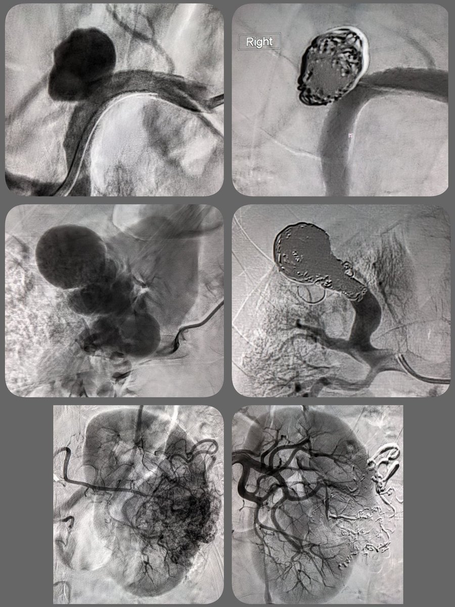 Justin Greene (@greenerads) on Twitter photo Renal intervention f/u day in clinic. stent assisted coiling of enlarging renal artery aneurysm, high flow renal AVshunt, and glue embolization of renal AML. All #transradial. @rkryu <a href="/ManuSinghMD/">Manu Singh</a> <a href="/CDoeVIR/">Christopher Doe</a> <a href="/SDhandMD/">Sabeen Dhand</a> @JeremyKimMD <a href="/Daryl_Goldman/">Daryl Goldman MD</a> <a href="/msran124/">Mona Ranade</a> <a href="/keithppereira/">Keith Pereira MD, #VIrad</a> Renal intervention f/u day in clinic. stent assisted coiling of enlarging renal artery aneurysm, high flow renal AVshunt, and glue embolization of renal AML. All #transradial. @rkryu <a href="/ManuSinghMD/">Manu Singh</a> <a href="/CDoeVIR/">Christopher Doe</a> <a href="/SDhandMD/">Sabeen Dhand</a> @JeremyKimMD <a href="/Daryl_Goldman/">Daryl Goldman MD</a> <a href="/msran124/">Mona Ranade</a> <a href="/keithppereira/">Keith Pereira MD, #VIrad</a>