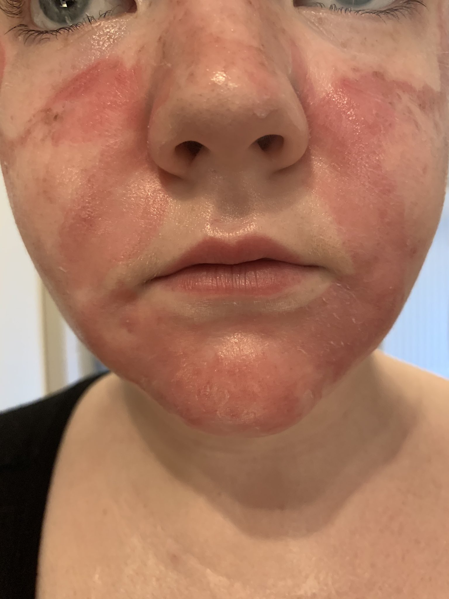 Chemical Burns On Face