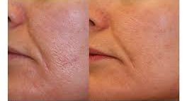 If the pores are left for a long time, a person can get #blackheads &amp; #acne.
We have a range of advanced treatment options that can be used to treat individual needs.Your doctor will examine your skin to see which  treatment is right for you.
Visit iht.health