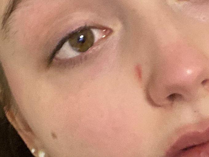 I got new nails and now they are so sharp I cut my face in my sleep and have a boo boo🥺 they&rsquo;re cute