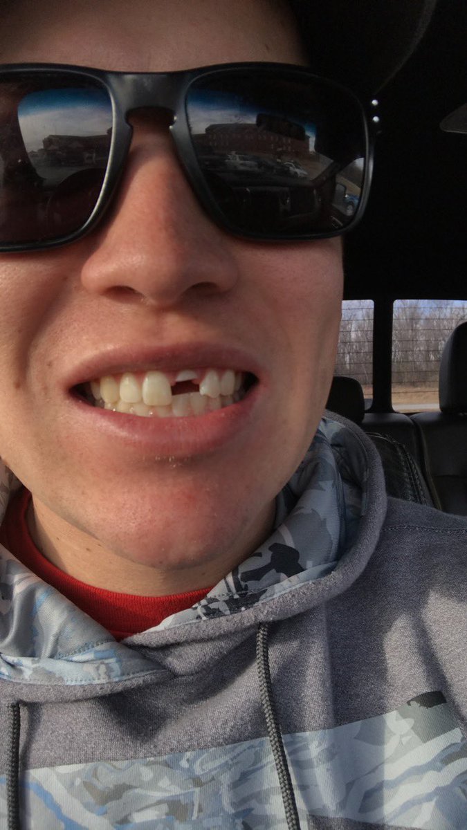 MitchellJ18's tweet photo. My kids are gonna sing “My daddy served in the army when he lost his right tooth!” https://t.co/sf8wWVdyGT