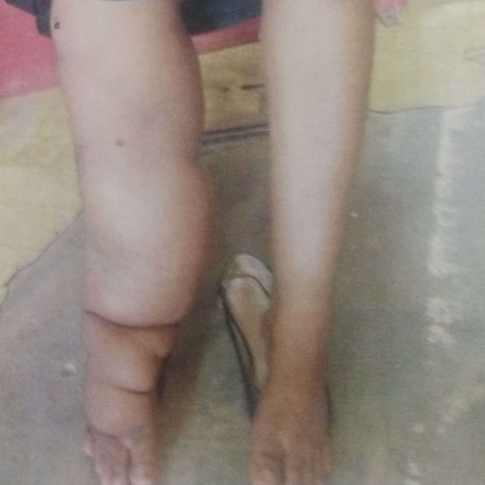 hashsudan's tweet image. 🔴فتاة سودانية مريضة انسداد الاوعية الليمفاوية في أحد الاقدام ، لم تستطع العلاج في السودان ، وتعاني حالياً من ظروف مادية صعبة، تبحث عن من يساعدها من أهل العطاء والبر لأجل السفر للخارج بغرض إجراء عملية
  رقم حساب للدعم
 2351434
بنك الخرطوم فرع المنشية
للتواصل
0960706683
#ريتويت