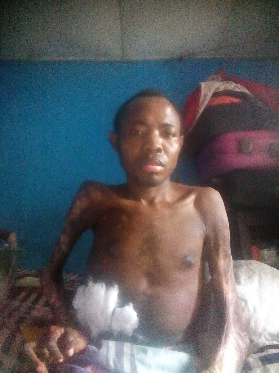KaluKaris's tweet photo. @chidinmaekile Am not ashamed anymore maybe wen you see my pic u know I really need your help am a sickler &amp;,4 8yrs now I can't walk due to spinal cord bone injury &amp; oestoemalitics of d knee pls helpme so I can go 4treatment,pls safe me frm dis pains God bless you #DavidoXYonda  08139720887 https://t.co/I7P1LzIrYh