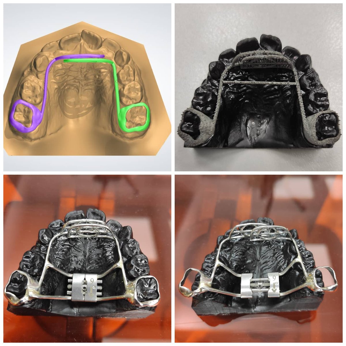 Bir beğendiğininizi alırım👍 ☺️ Çok güzel oldu, dijital tasarım, kuyumcu özverisiyle finalizasyon😎  @manavgatortodonti Dr. Pınar Şahin Veske hanımın tasarımı yönlendiren yerinde müdahaleleri " #RPE + #habitbraker 🤓 Bitmişini merak ettiğim işlerdendi.☺️