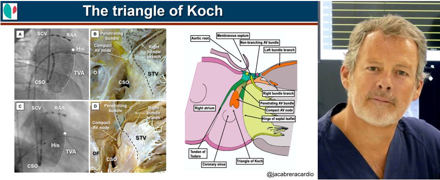 AnneNeubert1's tweet photo. 2/ Prof. Cabrera @jacabreracardio starts on Anatomic Correlations of Supraventricular Arrhythmias. #IFPdigital #Epeeps #CardioTwitter #triangleofkoch https://t.co/7Tauh6eGD0