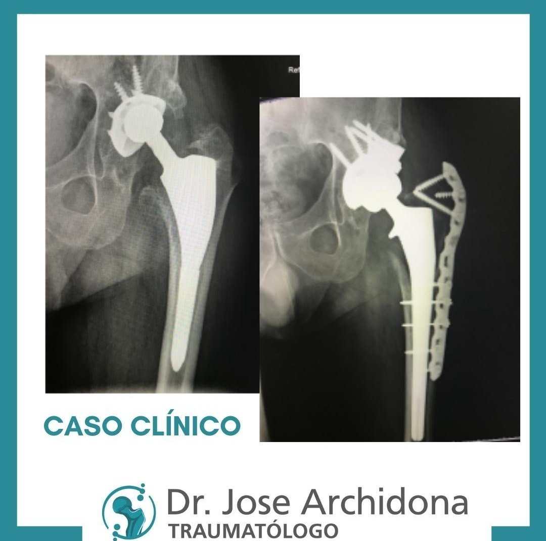 josearchidonat2's tweet photo. 🔹Caso clínico🔹
Varón. 68 años. Coxalgia izquierda invalidante.

Caso completo en https://t.co/lSGQpddSkL
#josearchidonatraumatologo #Murcia #traumatologia #traumatologo #salud #sanidad #regiondemurcia #coxalgia #casoclinico https://t.co/McKmoGMcIO