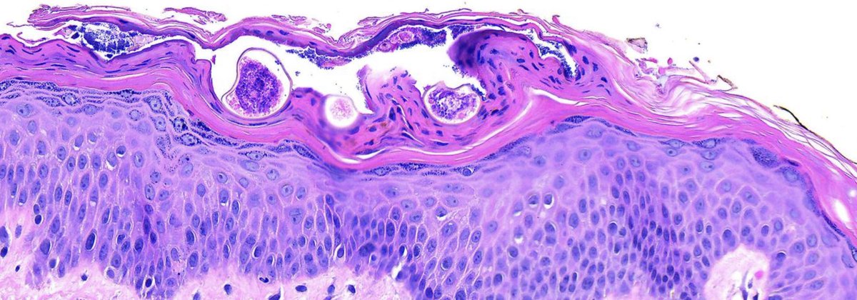 While quarantined and working from home - caught this case - r/o PLEVA -  was fortunate to catch this little critter in the recuts! #Scabies #dermpath #rarelyPLEVA #imgettingitchy 

Images from #MoticEasyScan by <a href="/MoticPathology/">Motic Digital Pathology</a>
