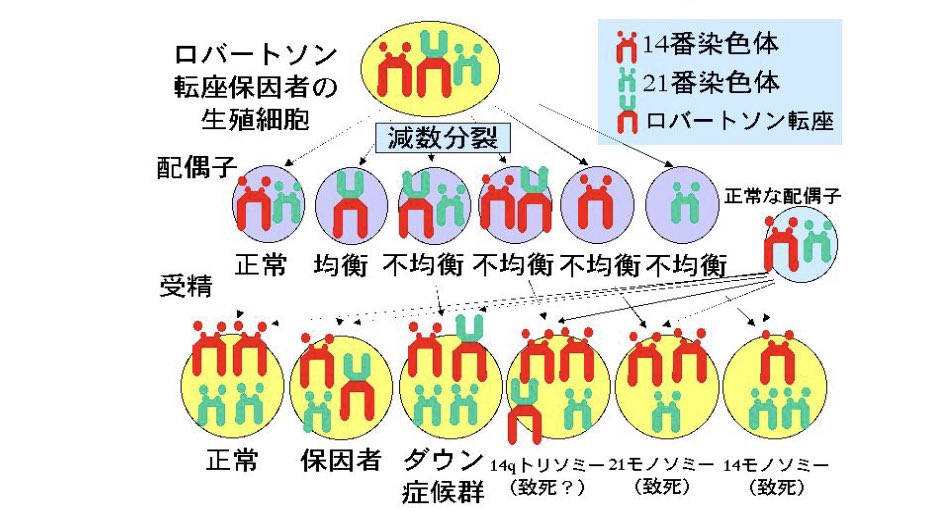 drゴクウ twitterren 疾患名と核型の所見が別という意味ですね 例えばロバートソン転座によるダウンでは21番染色体が単純に3本あるのとは異なります この転座型の21トリソミーでは 次子もダウンである確率が偶然による場合より高くなります 稀ですが 21番内での転