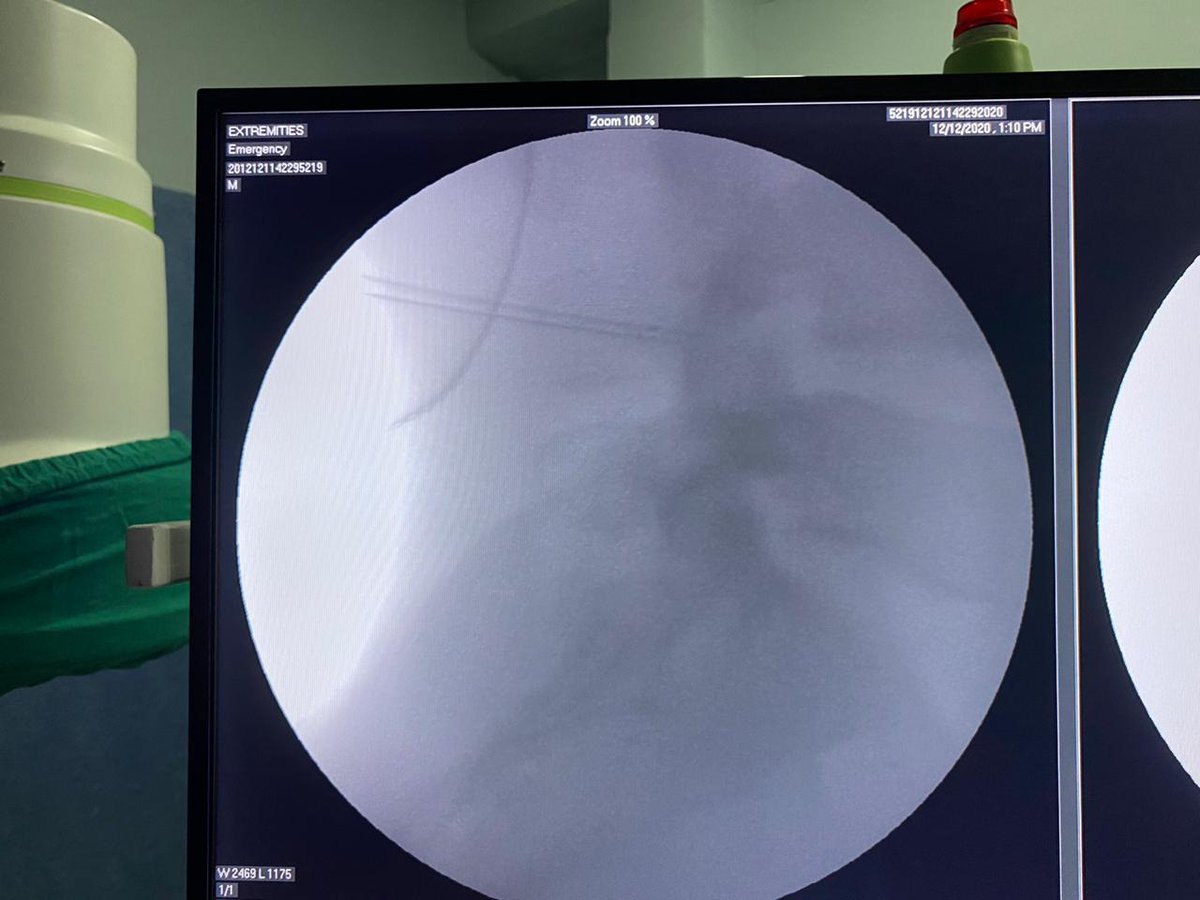 abhisesh's tweet photo. Radiofrequency Ablation of Median Branch for chronic back pain with facet arthropathy https://t.co/vUGiOK7LUT