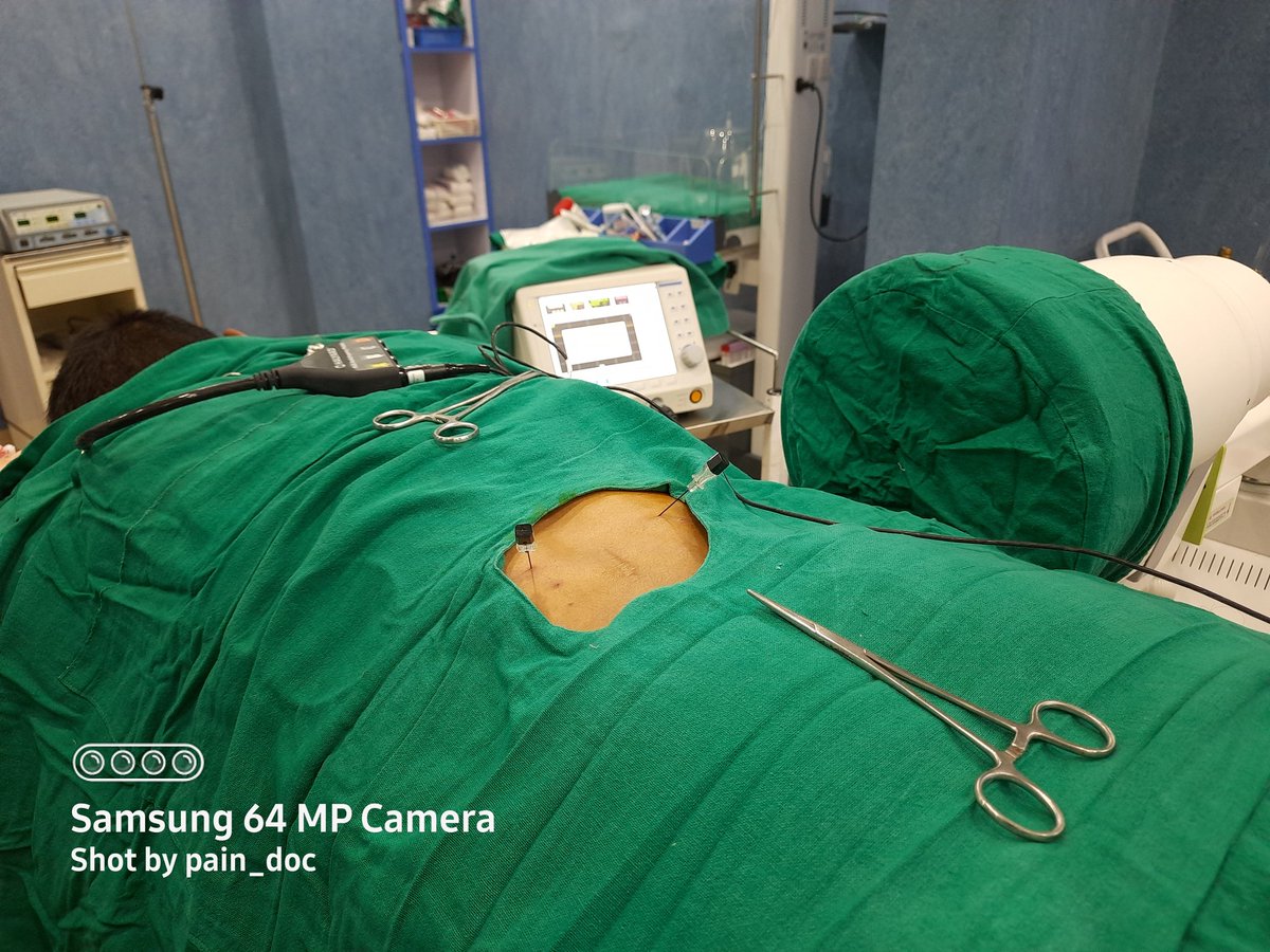 abhisesh's tweet photo. Radiofrequency Ablation of Median Branch for chronic back pain with facet arthropathy https://t.co/vUGiOK7LUT