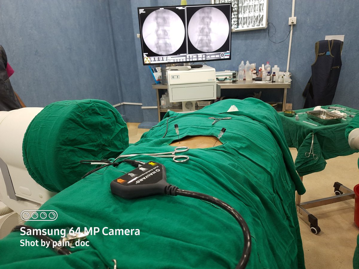 abhisesh's tweet photo. Radiofrequency Ablation of Median Branch for chronic back pain with facet arthropathy https://t.co/vUGiOK7LUT