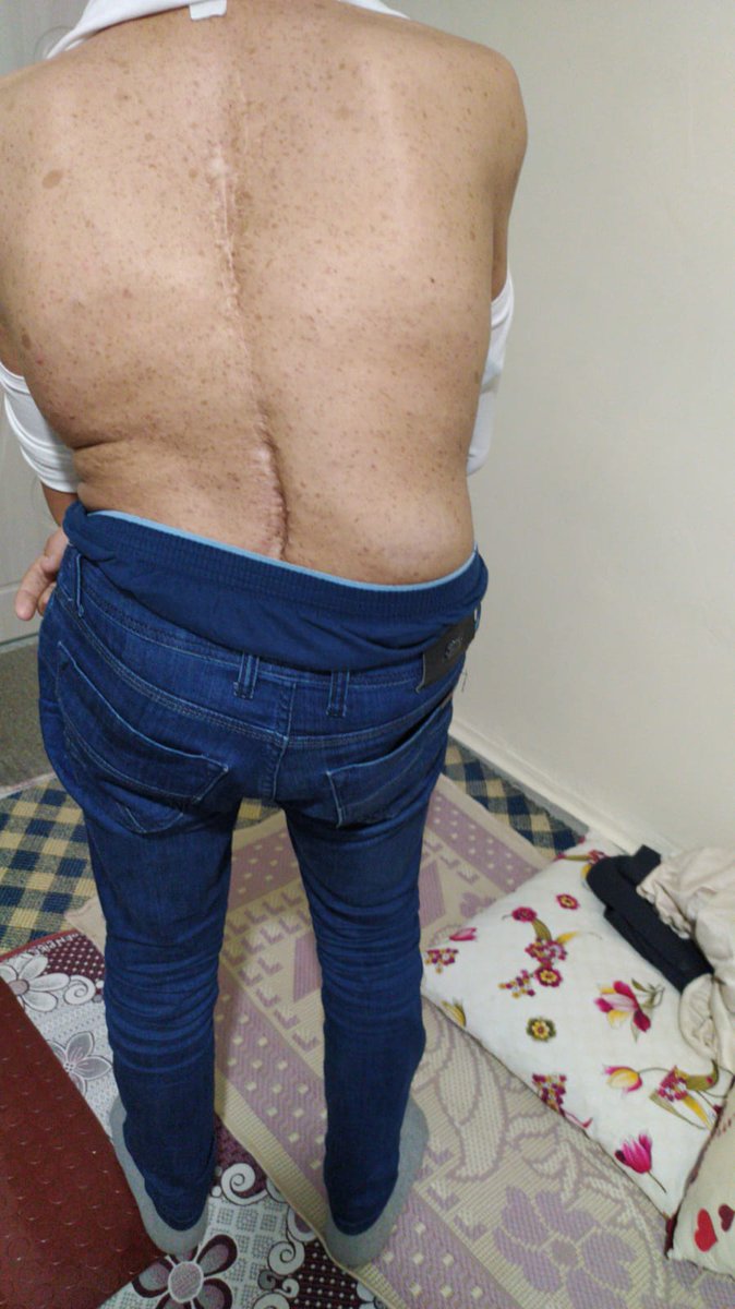 Umutsende5's tweet photo. Sizlere Yakup kardeşimizden bahsetmek istiyorum ! Yakup Siirt/Pervarili 18 yaşında  Skolyoz hastası bir genç. 10 yılda 4 defa ameliyat oldu bu kadar ameliyat olmasının tek nedeni vardı.  Sağlığına kavuşmak ve arkadaşları gibi normal yaşama dönebilmek.🥺🙏🏻 https://t.co/nvSKxdTAbB