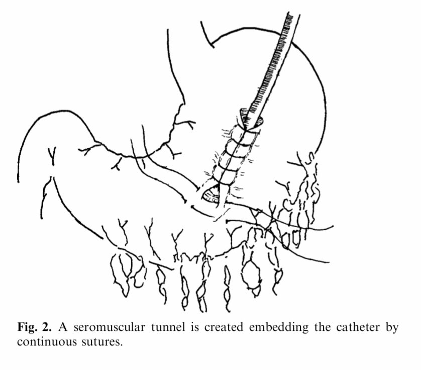 Cirbosque Some4surgery On Twitter Laparoscopic Witzel Gastrostomy Step By Step Some4surgery Medtwitter Juliomayol Swexner Pferrada1 Almagoch Pipecabrerav Salo75 Misirg1 Celestinogutirr Sages Updates Drthawaba Https T Co Enb4vznfig