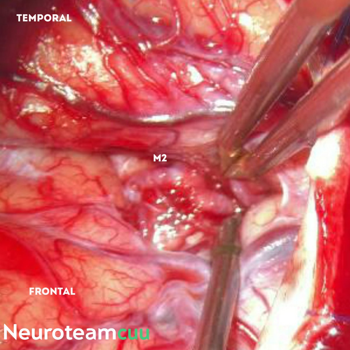 ordomd's tweet photo. Microsurgical M2 thrombectomy for acute stroke NIHSS 10 to 1 An option when Endovascular MT is not possible by either medical, economical or administrative cause - Leave no LVO behind!
@DrArturoMCobos @Ostorfi @Jose_Carlossss 
#stroke #microsurgery #neurosurgery #neuroteamcuu https://t.co/GFA8ieF6oh