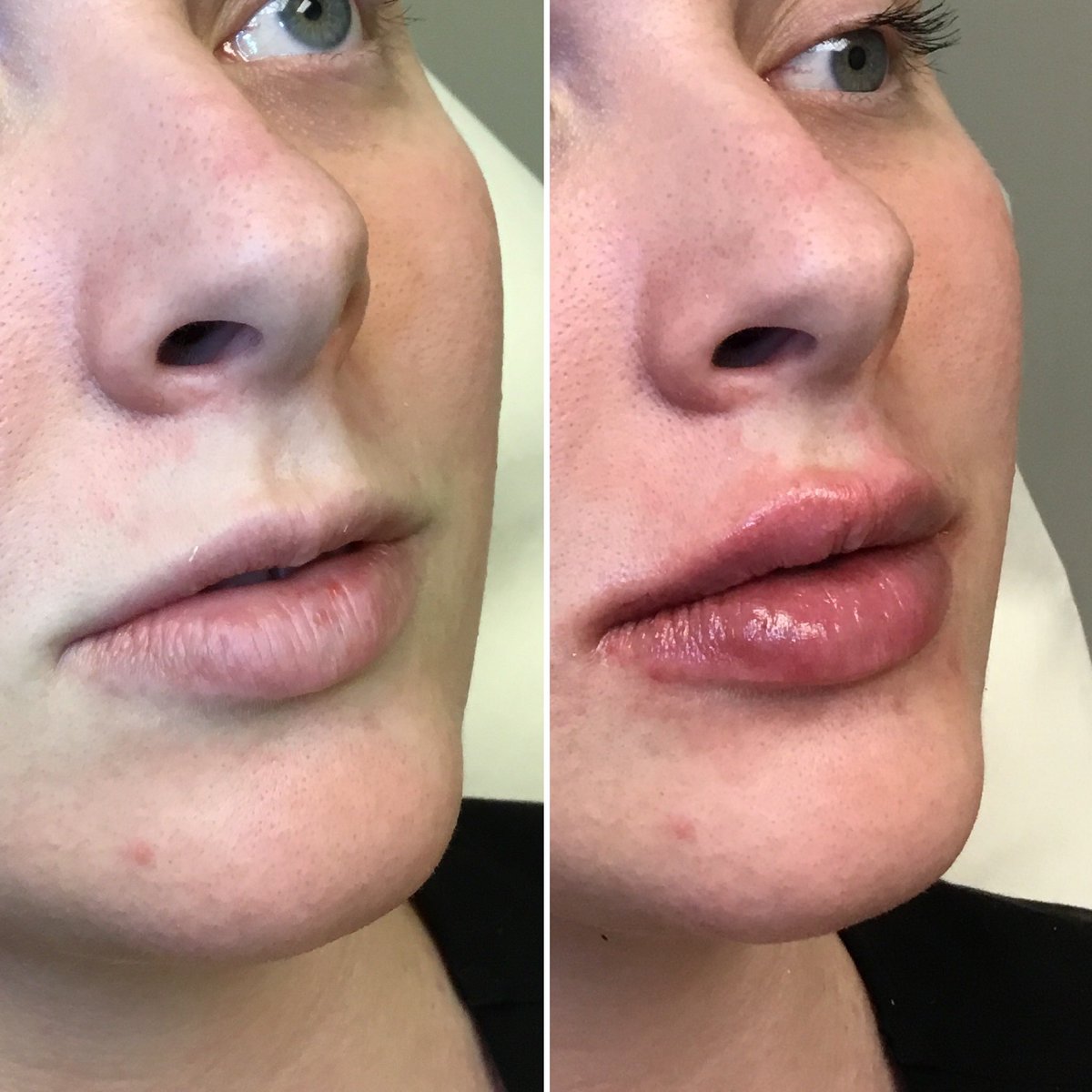 skinBeMedSpa's tweet photo. ⚠️⚠️⚠️

You will be hooked, don’t say we didn’t tell you so. 💙

We started with a lip flip and Restylane Refyne to start with a subtle enhancement for these virgin lips but she wanted more so we KYSSED her! 💋🔥 #WeekendviBes #PuckerUp #NewLippies https://t.co/xm0uNdEdMh
