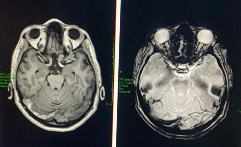 5/ as an example, today we attend a 44 year old woman, abandoned by her husband with three children in the middle of the  #pandemic, who had an acute onset of affective and cognitive abnormalities, hallucinations and catatonia. MRI shows a cerebral venous trombosis. 