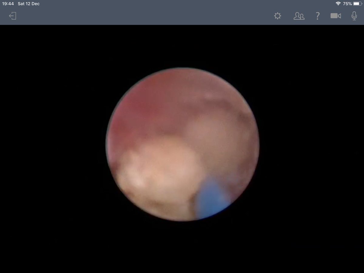 PetkovaKremena's tweet photo. Great presentation on pediatric mini PCNL by @migokce at #ESPULearn webinar https://t.co/ws4k76CGhd