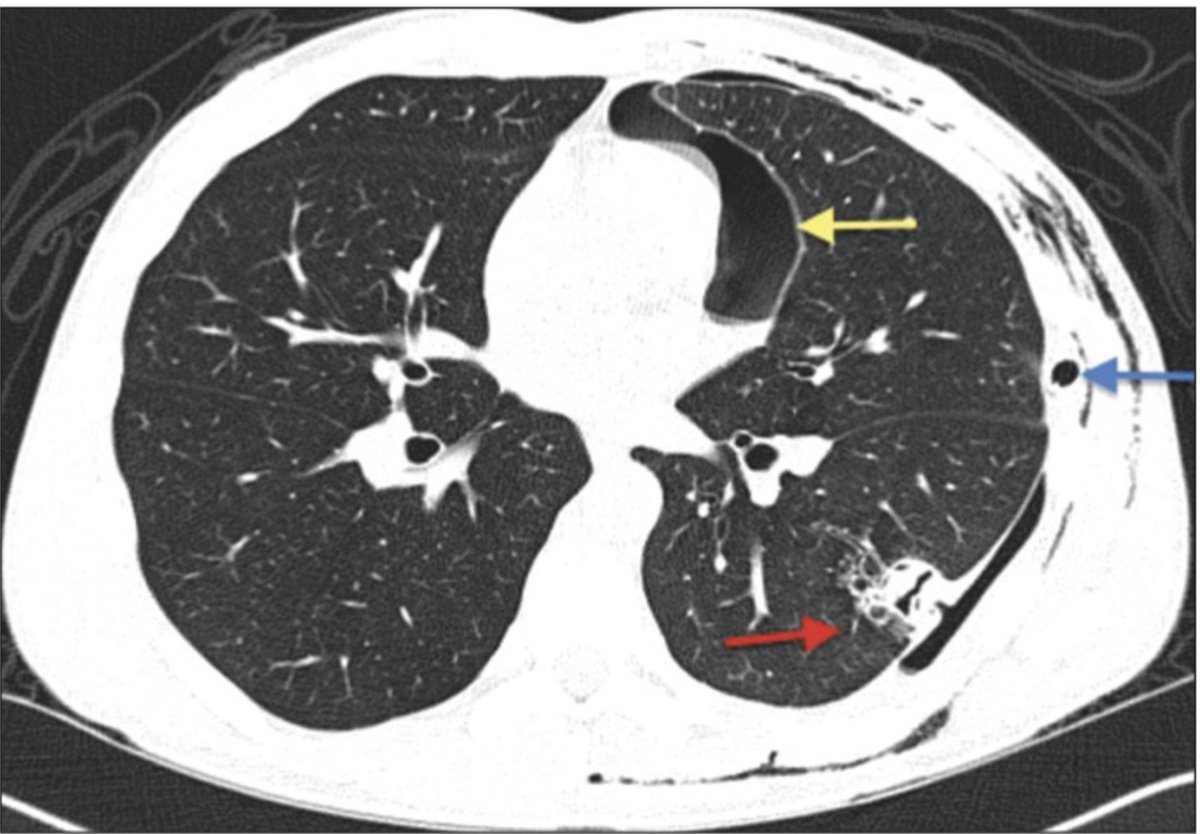 If you don't have this, you have no proof of lysis and can only measure the Epiphytes. However, it's the Endophytes like Aspergillus that are responsible for the only clinical fatalities in the cannabis space. People don't overdose on THC. But Aspergillosis is serious.