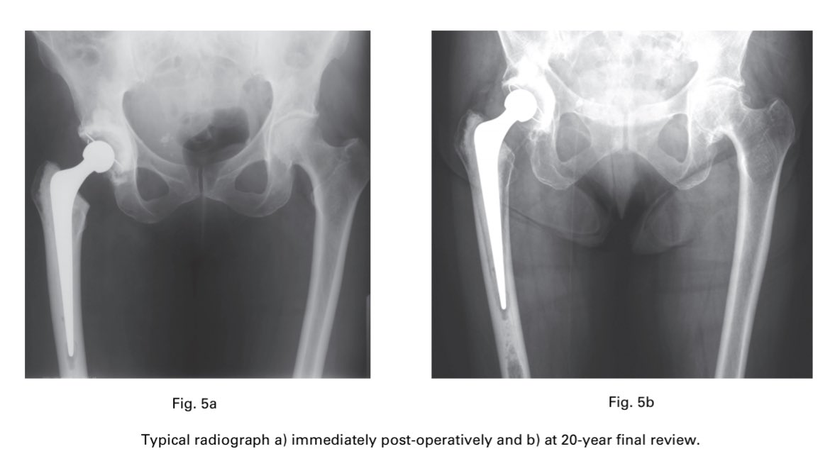 Look at previous tweets for why the femur is preserved. More to come in the next few weeks. Not a bad looking femur at 20 years post-op.  #orthotwitter  #ExeterHip50