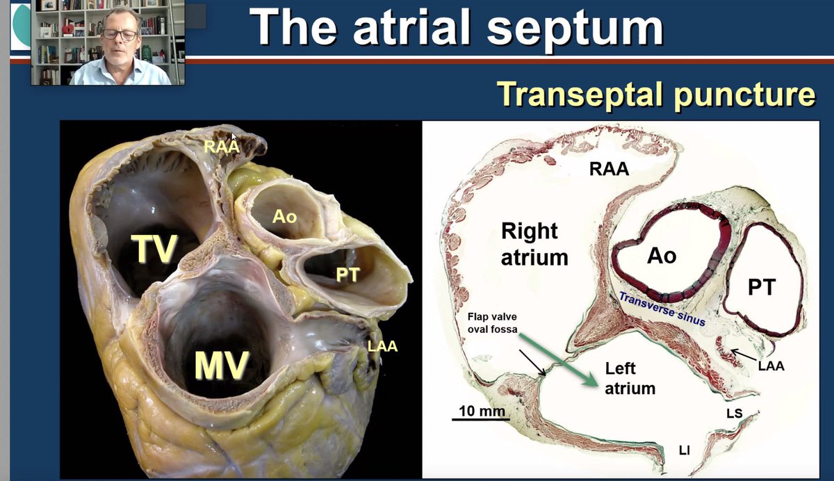 ChasanR's tweet photo. It was a great #SVT Session #IFPdigital with an Overview of Anatomy @jacabreracardio as well as #AVNRT with @HH4EHRA and #accessorypathways with Warren Jackman
➡️ Thanks for the friendly moderation of @EPDeneke & @SteffelJ
@Dominik_Linz @dr_pmueller
@AnneNeubert1 @iwalux_77 https://t.co/PsfhTtJCoG