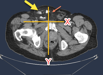 Here is a hernia which is ventral to x line and extends medial to the Y line; indirect inguinal hernia

Abdom Imaging; . 2007 Nov;32(6):803-6.
