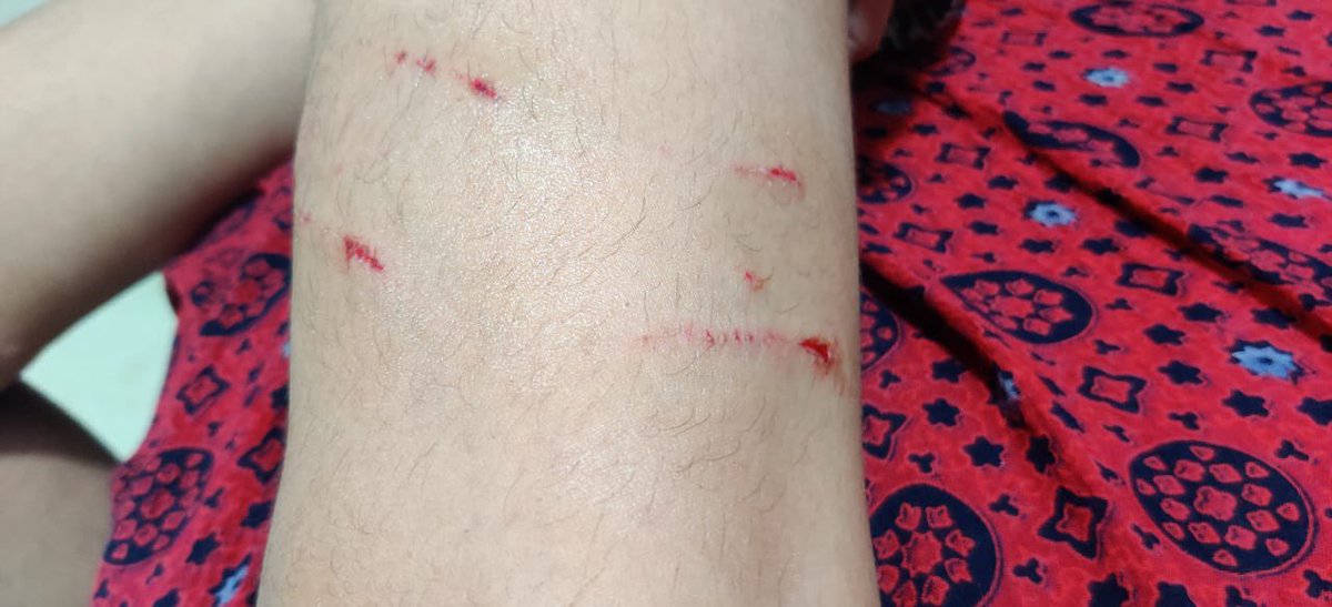 jagdishshetty's tweet photo. The stray dog menace in Kalpataru Aura at Ghatkopar is going on and @mybmc &amp; MCGM of N ward are not able to do anything ! Yesterday a 20 years old was bitten badly ! Time for @mybmc to act firmly ! Numerous cases in the past https://t.co/rqhWrrX0OX