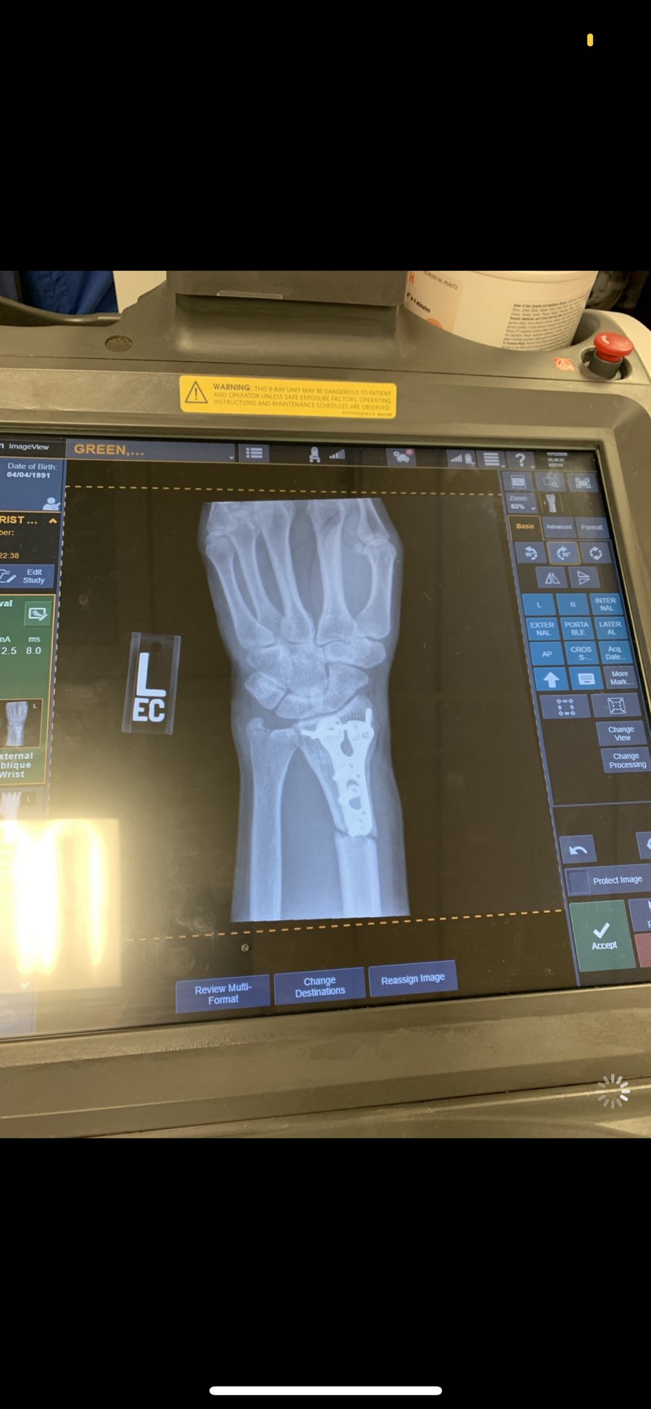 Chelsea Green Shows Off Disturbing Scars From WWE Smackdown Wrist Injury 2