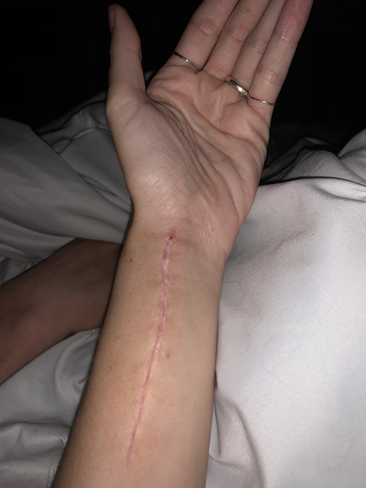 Chelsea Green Shows Off Disturbing Scars From WWE Smackdown Wrist Injury 1