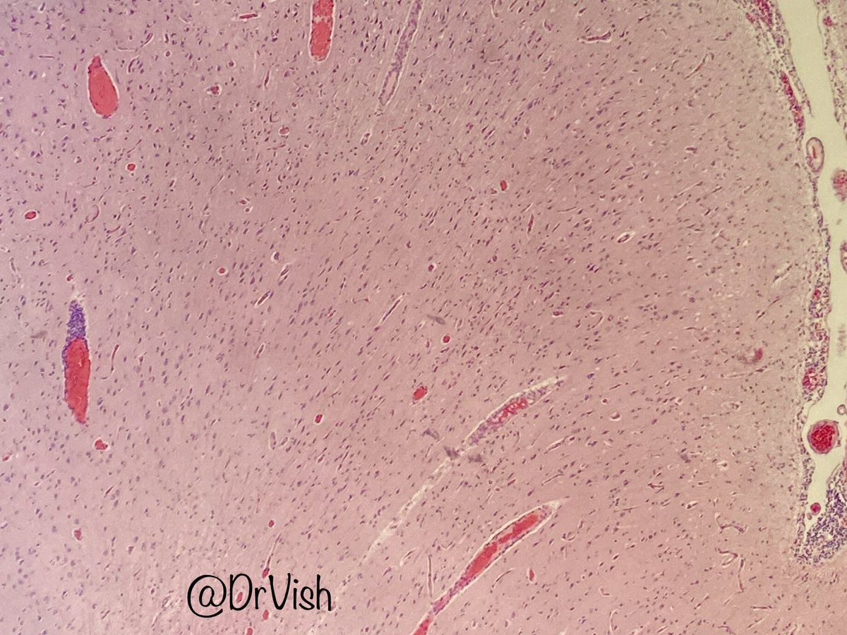DrVish's tweet photo. Male in 20’s with seizures #pathfiles #pathtwitter #patheducation #neuropath #pathology @BrainsSlicer @EviAbadaMD @Dr_Brian_Cox @kkuanMD @padmapathology1 @debpratik @Gagandeepk5MD @Sujata_path @Miryousufkhan3 @Huy_NguyenMD @Meghna0630 @PathSpotters @pathpuzzlers @Florwrn https://t.co/IQFbpCTwLO