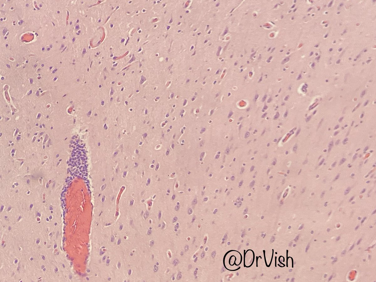 DrVish's tweet photo. Male in 20’s with seizures #pathfiles #pathtwitter #patheducation #neuropath #pathology @BrainsSlicer @EviAbadaMD @Dr_Brian_Cox @kkuanMD @padmapathology1 @debpratik @Gagandeepk5MD @Sujata_path @Miryousufkhan3 @Huy_NguyenMD @Meghna0630 @PathSpotters @pathpuzzlers @Florwrn https://t.co/IQFbpCTwLO