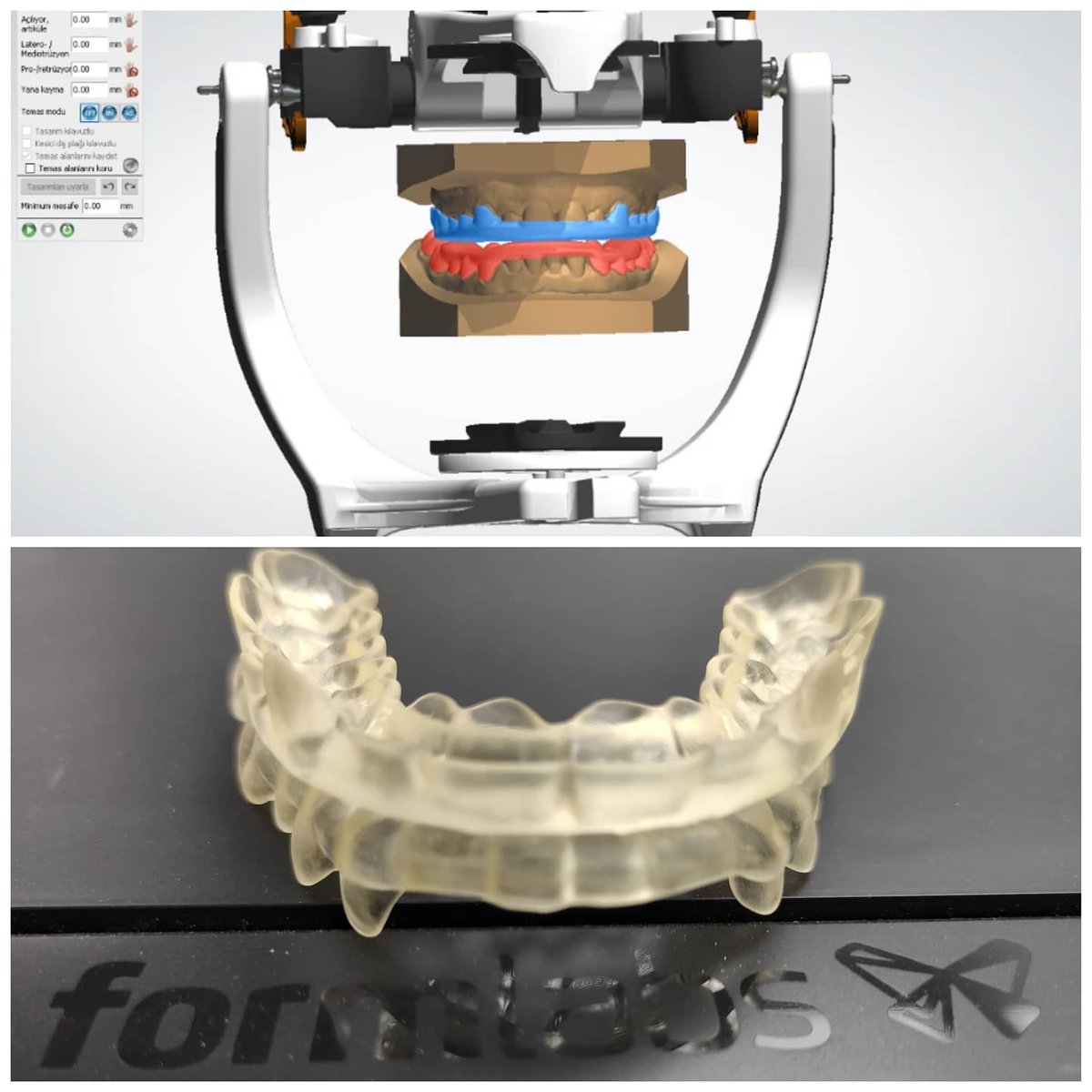 Dijital ortodontik çalışmaları çok yakından takip eden, bize de sürekli inovatif yeni icatlar çıkartan😂 #orthodontist Dr <a href="/shahinbarish/">şahin barış</a> ile çalıştığımız #tripodsplits hazır 😎 Çok yakında, yeni bir tasarım üzerinde de çalışıyoruz 🤓 Destekleriniz için teşekkürler <a href="/BTechInnovation/">BTech Innovation</a>